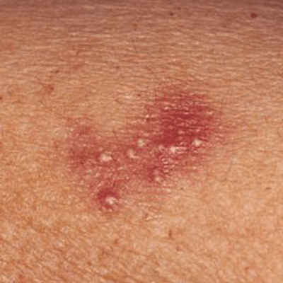 Genital Uçuk Nedir?