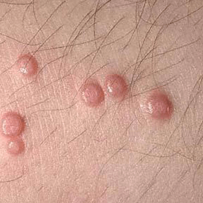 Molluskum Kontagiosum Tedavisi