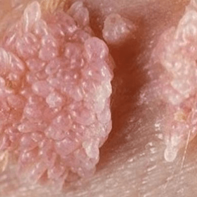 Genital Siğil Nasıl Bulaşır?